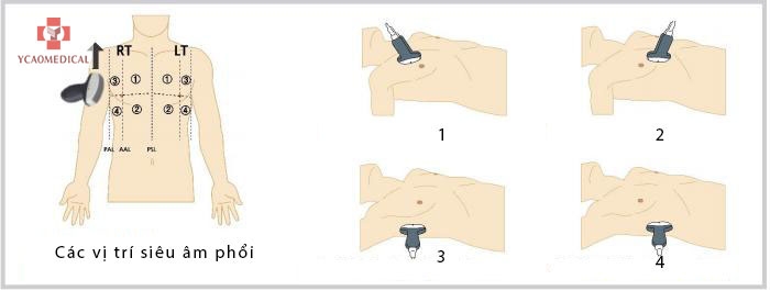 phac do sieu am phoi cho viem phoi covid 19